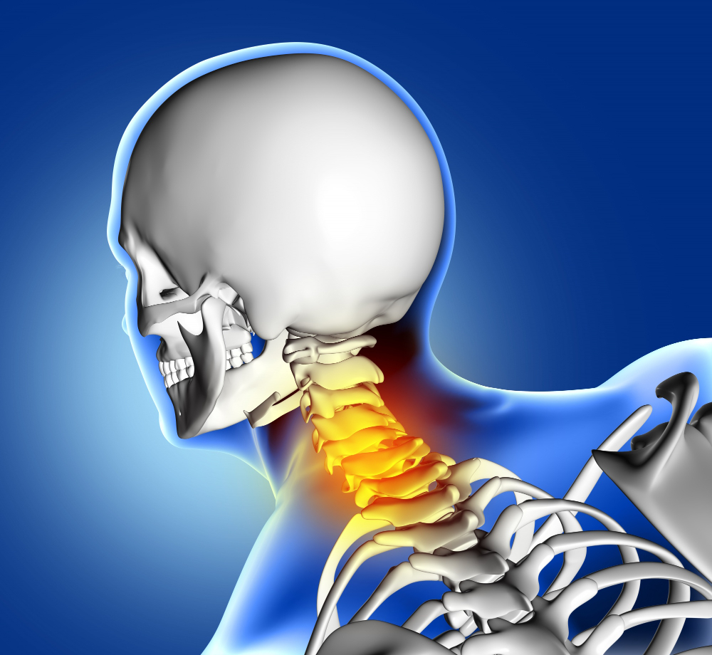 Cervical Spondylosis - Endoscopic Spine Surgeon